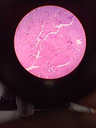 medullary thyroid carcinoma (mtc) imaging