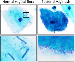 normal and abnormal flora in bacterial vaginosis