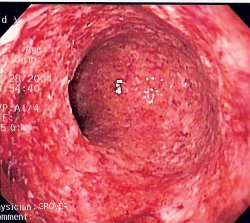 colitis inside the intestine
