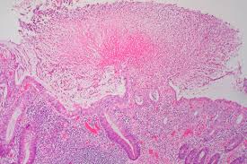 Pseudomembranous colitis under microscope