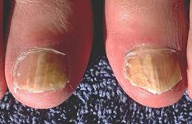 toenail with fungus
