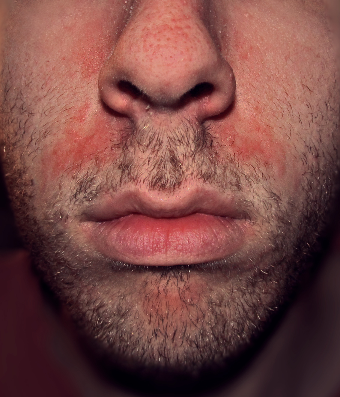 seborrhoeic dermatitis near moustache