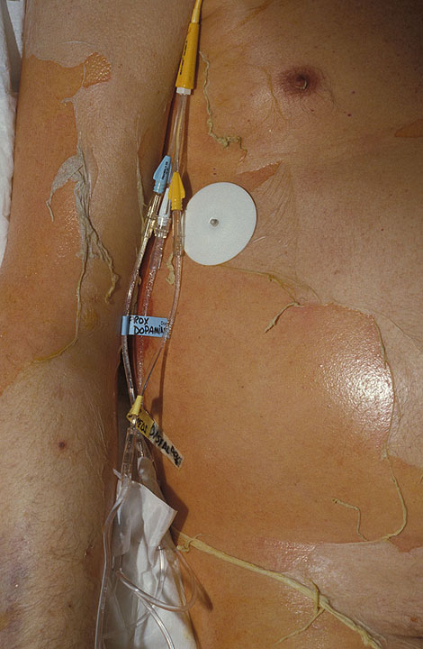 epidermal necrolysis of child