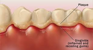 plaque and receding gums
