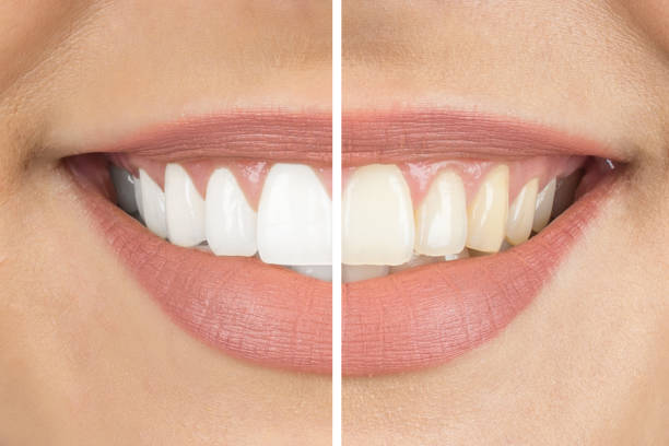 yellow and white teeth comparison