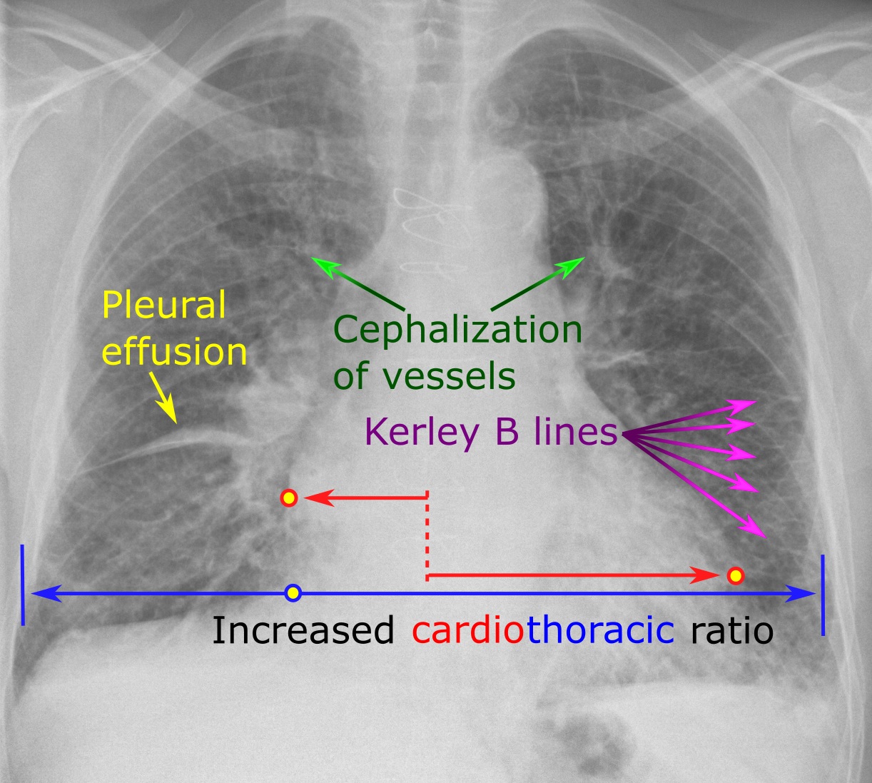 heart failure xray