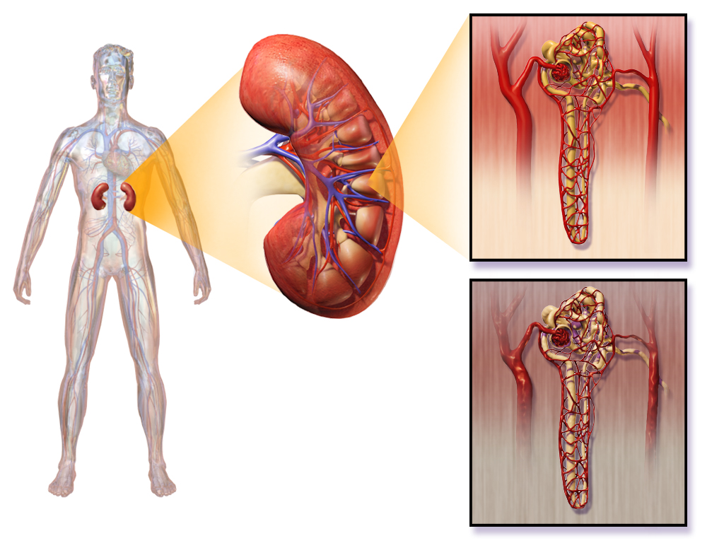 diabetic kidney disease in the kidney