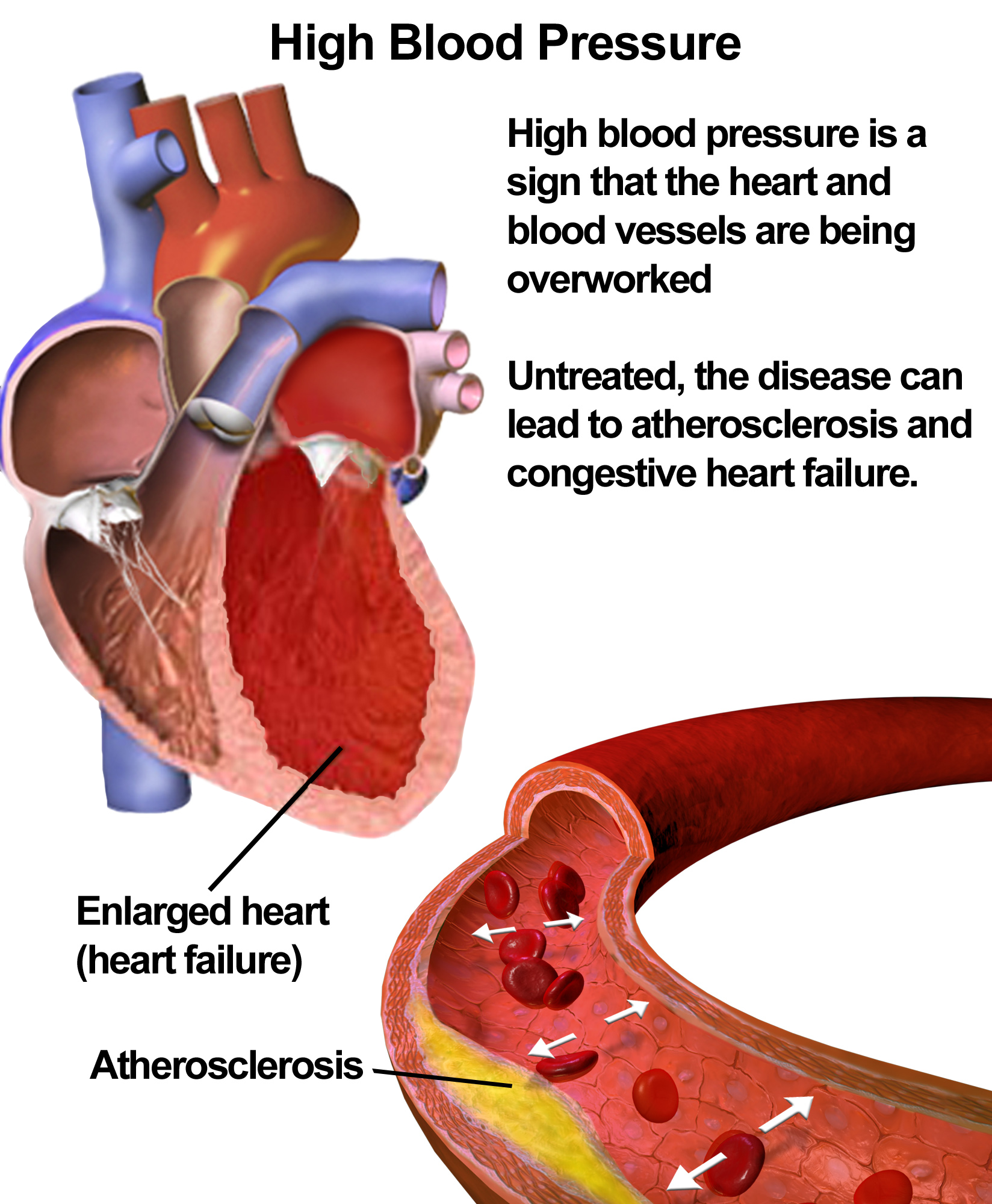 hypertension in the body