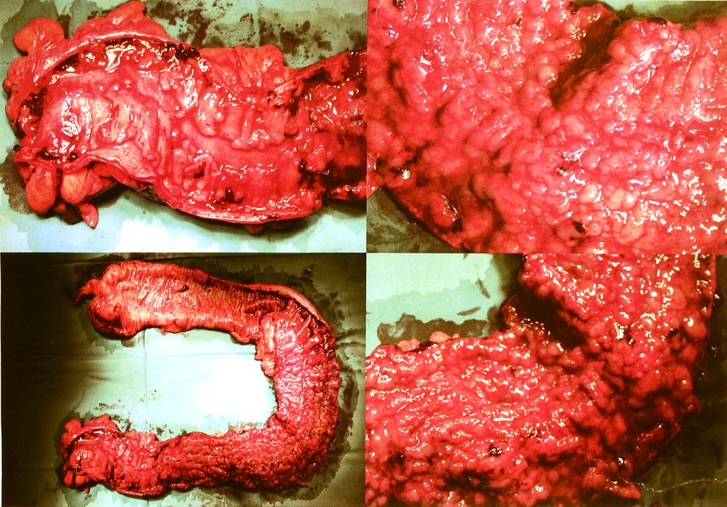 ulcerative colitis inside the stomach