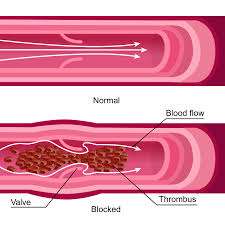 blood clot in the vein