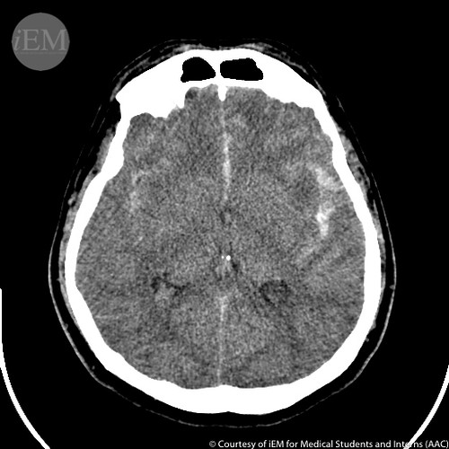 CT scan of Subarachnoid hemorrhage
