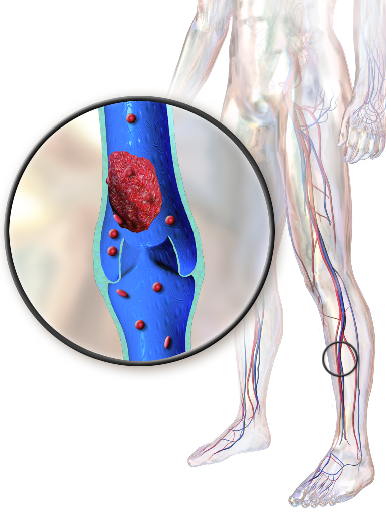 deep vein thrombosis on the right leg