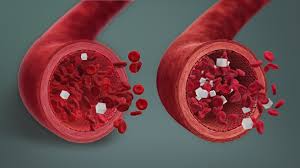 hypoglycemia in the blood vessels 
