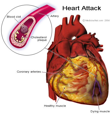 heart attack diagram