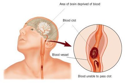 stroke in the brain