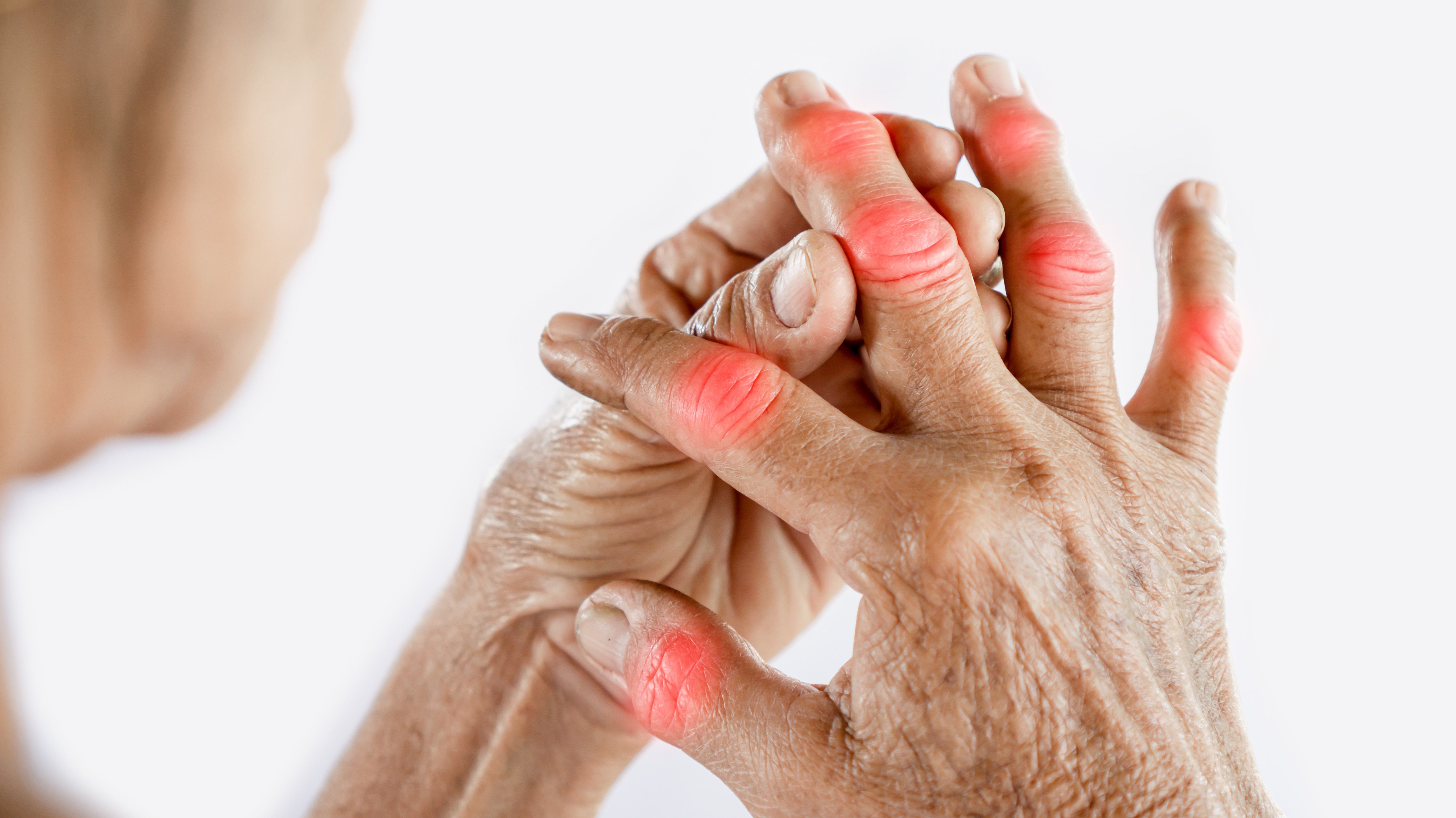 arthritis in the fingers 