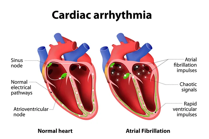 cardiac arrhythmias