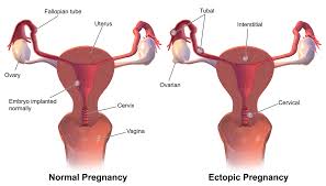 ectopic pregnancy in the uterus