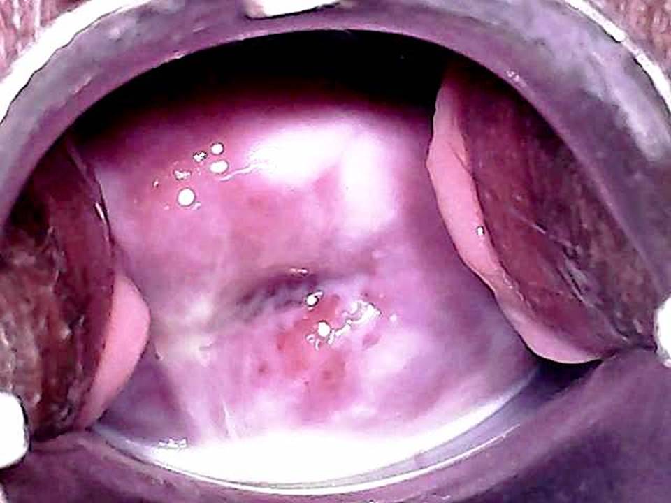 bacterial vaginosis