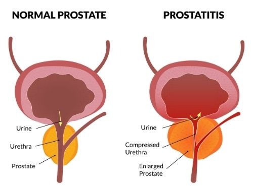 Chronic-prostatitis.