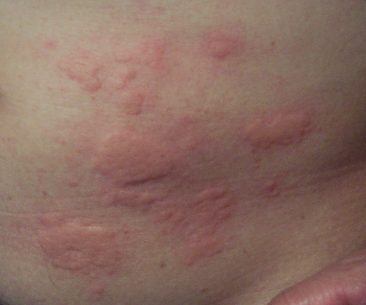 rashes on the skin