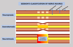 nerve damage