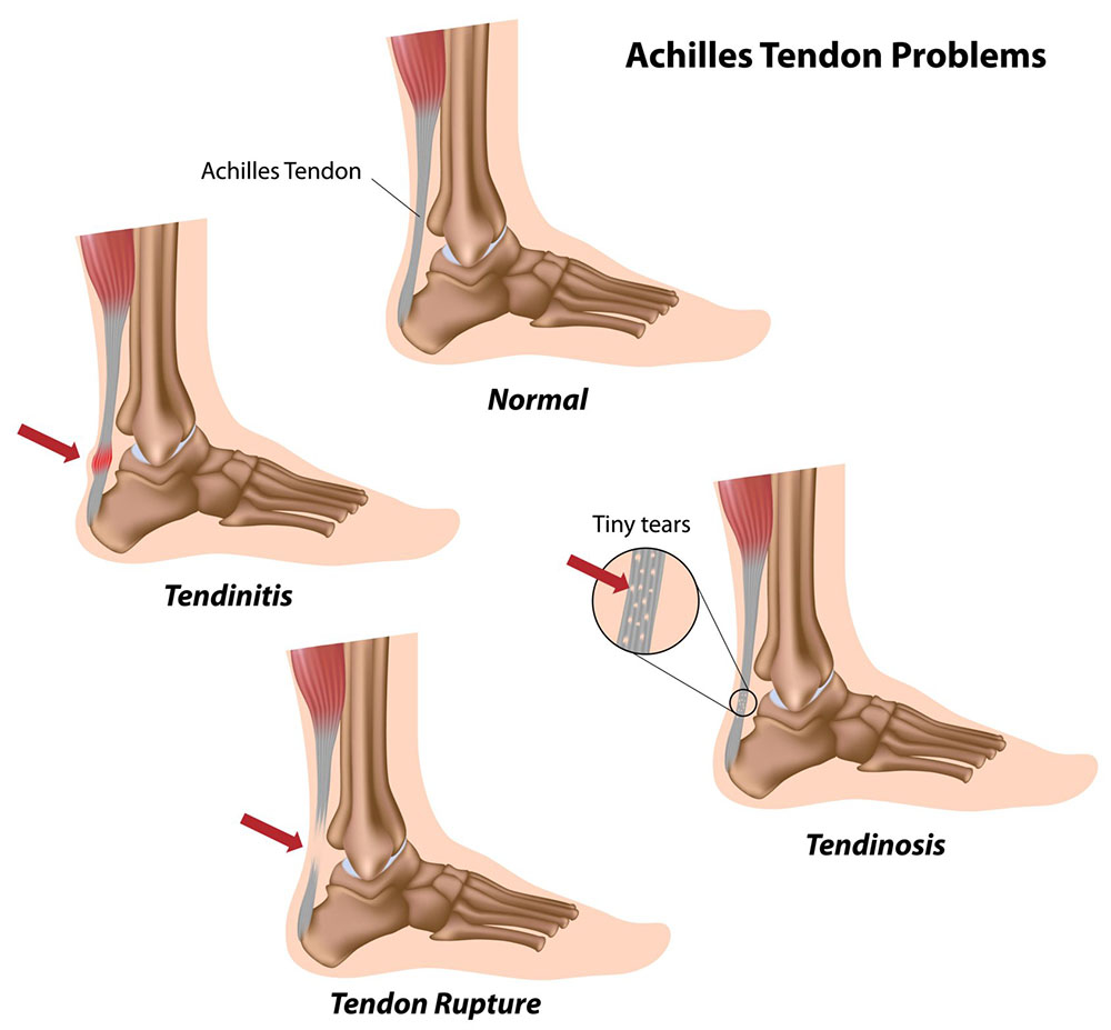 tendon damage