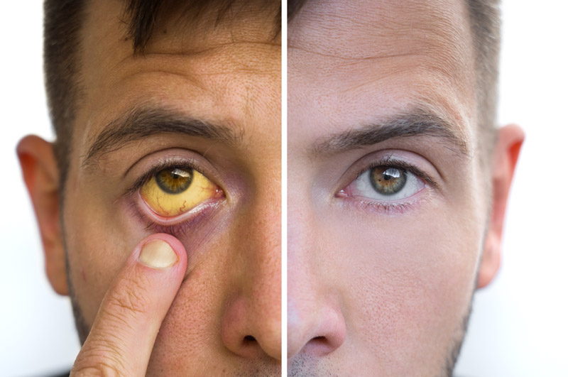 adult with jaundice