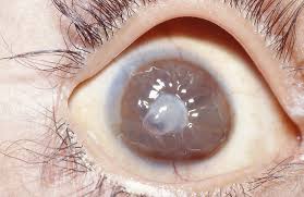 keratomalacia eye condition