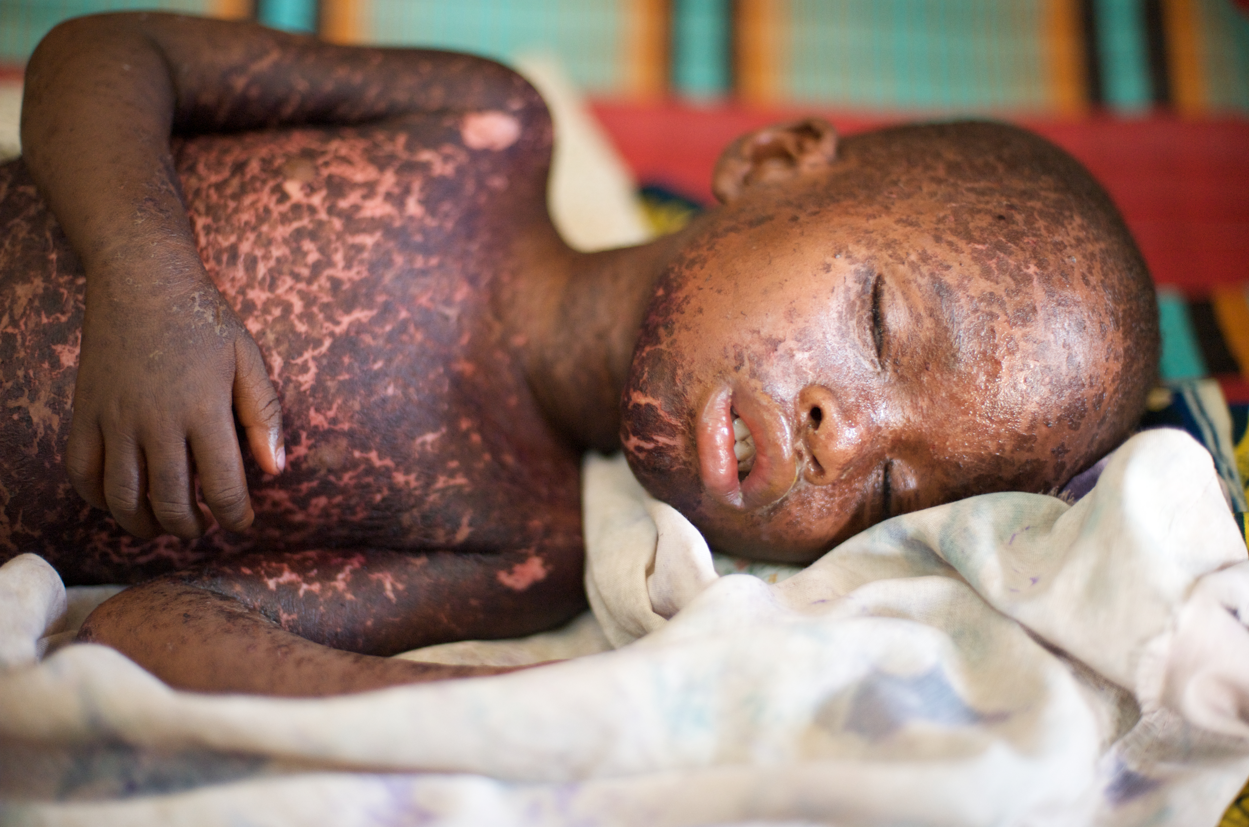 child laying on their side with measles