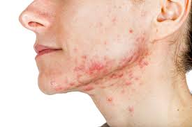 face with chin acne