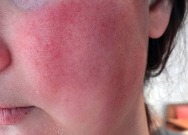 skin redness
