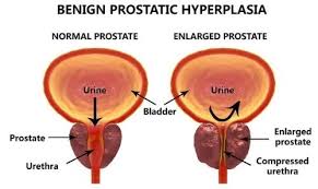 prostate-hyperplasia