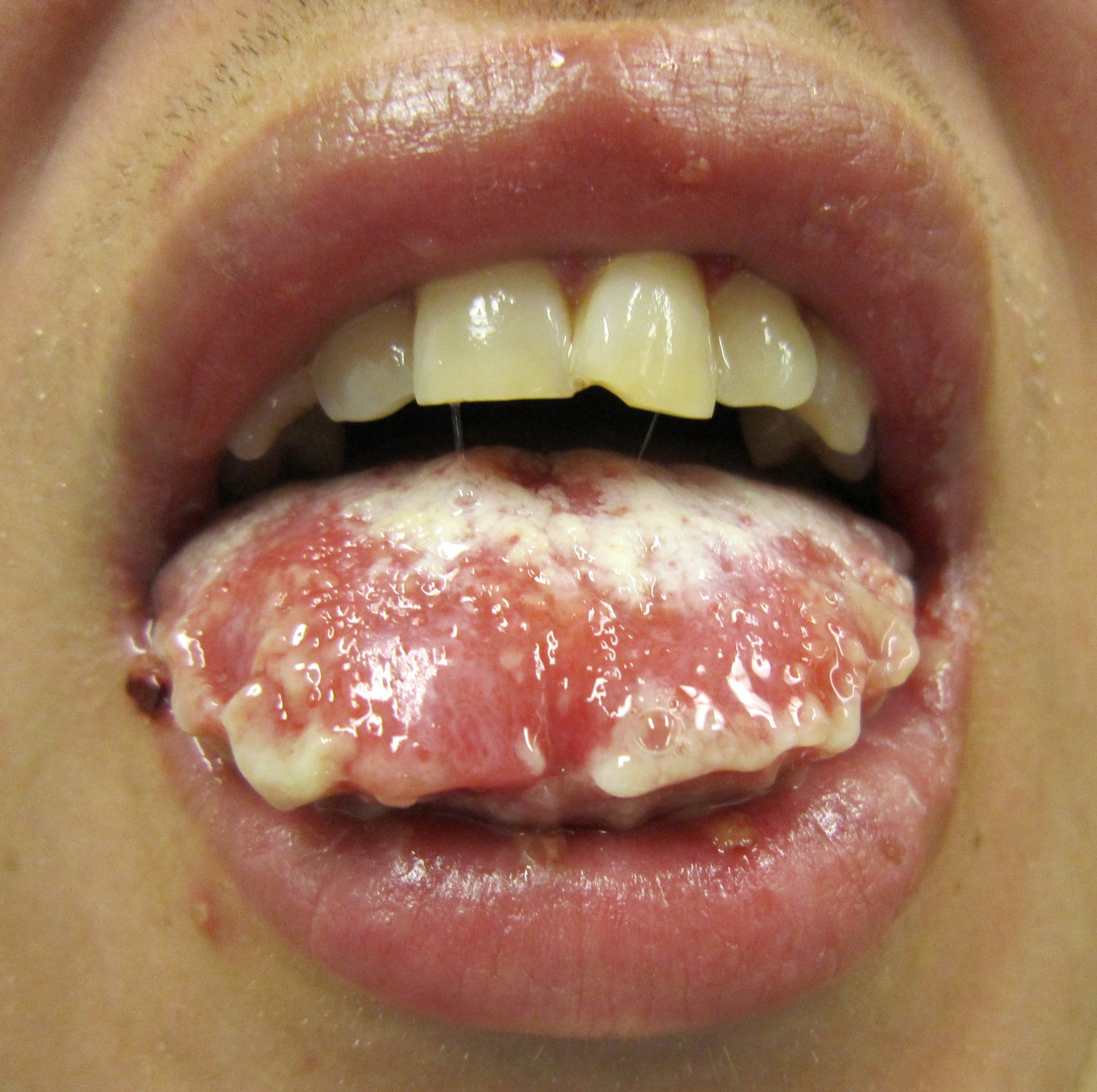 tounge with stevens johnsons syndrome