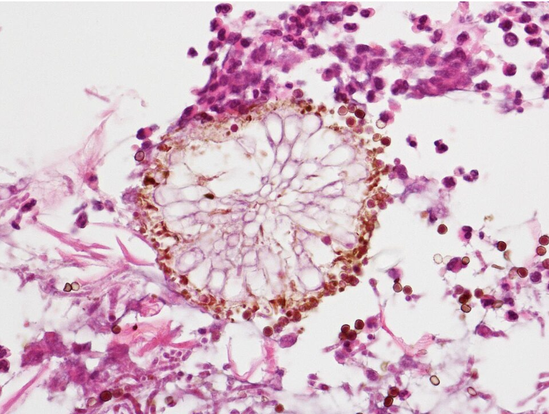 aspergillosis under the microscope