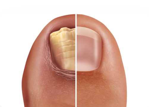 nail with and without fungal infection