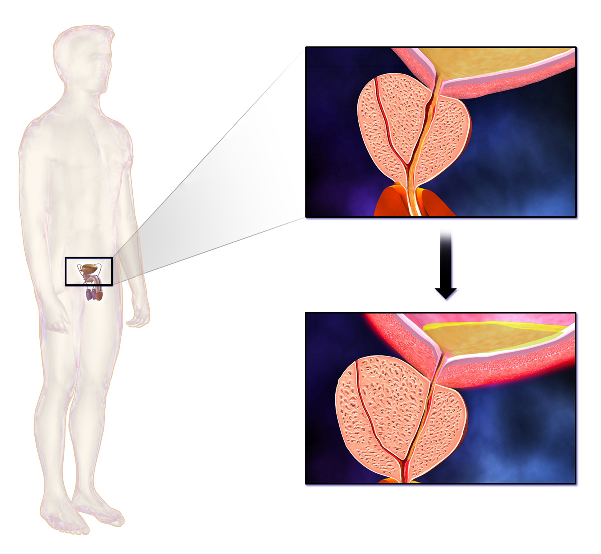  Benign prostatic hyperplasia (BPH)