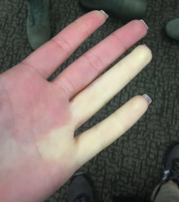 hand with reynaud phenomenon