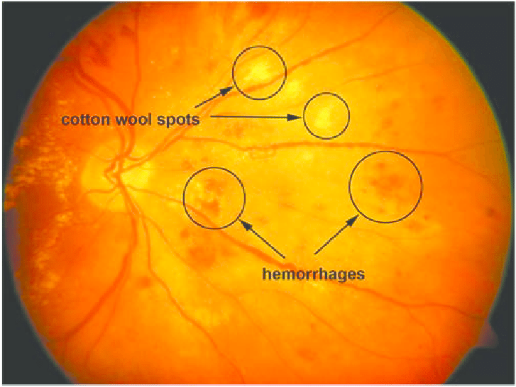 retinal damage
