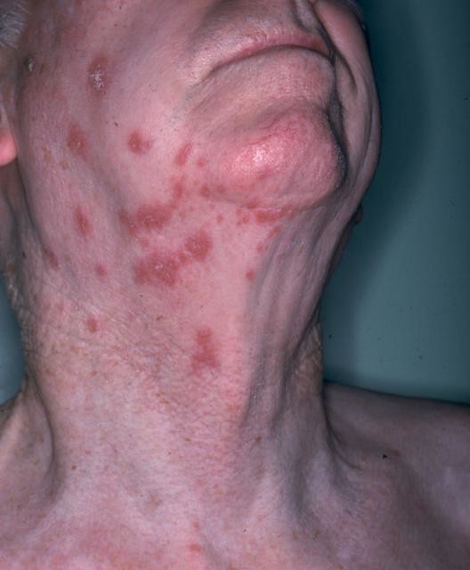 shingles on the neck