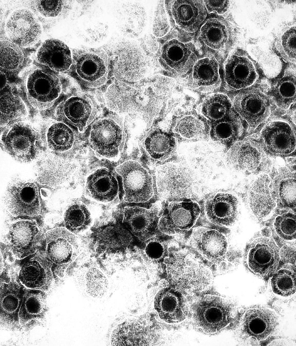 genital herpes virus