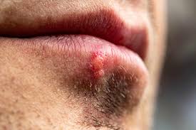 cold sore on the mouth
