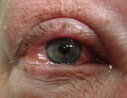 eye edema