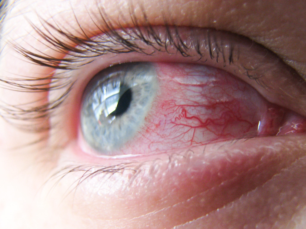 allergic conjunctivitis