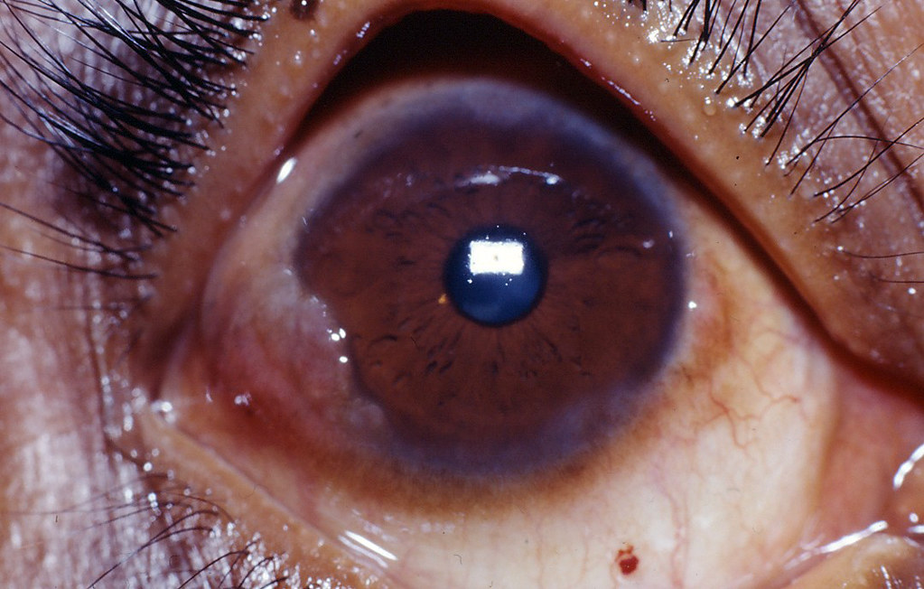 Vernal keratoconjunctivitis
