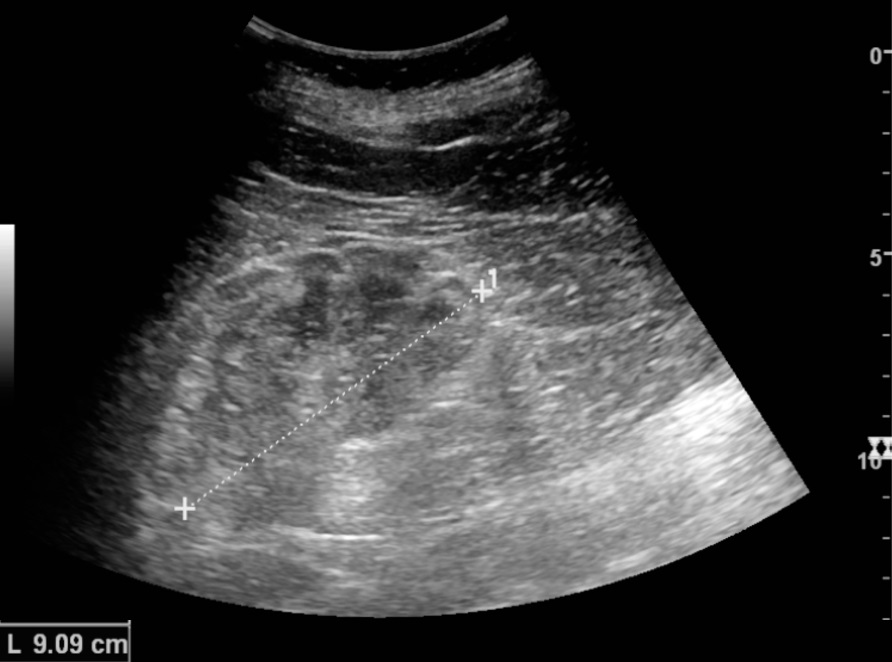 ultrasound of renal disease