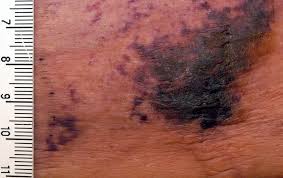 Calciphylaxis seen on skin