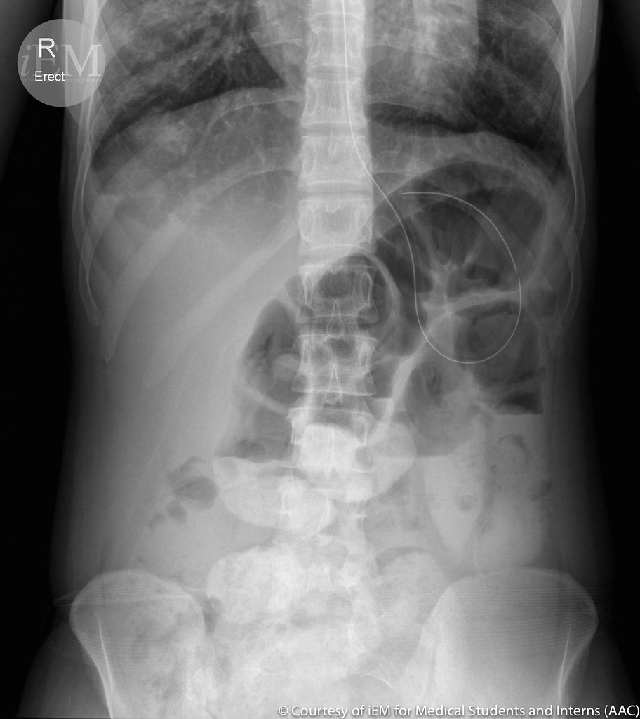 ultrasound of bowel obstruction
