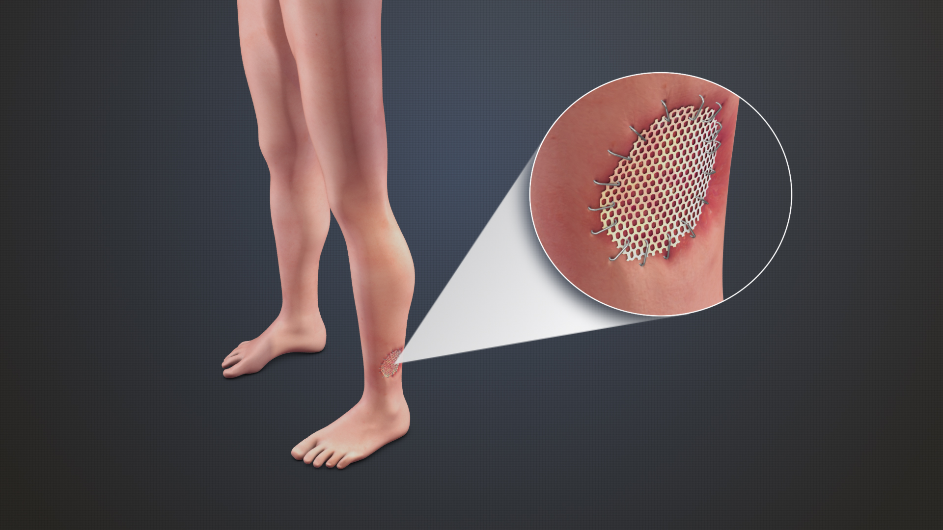 skin grafting on the leg