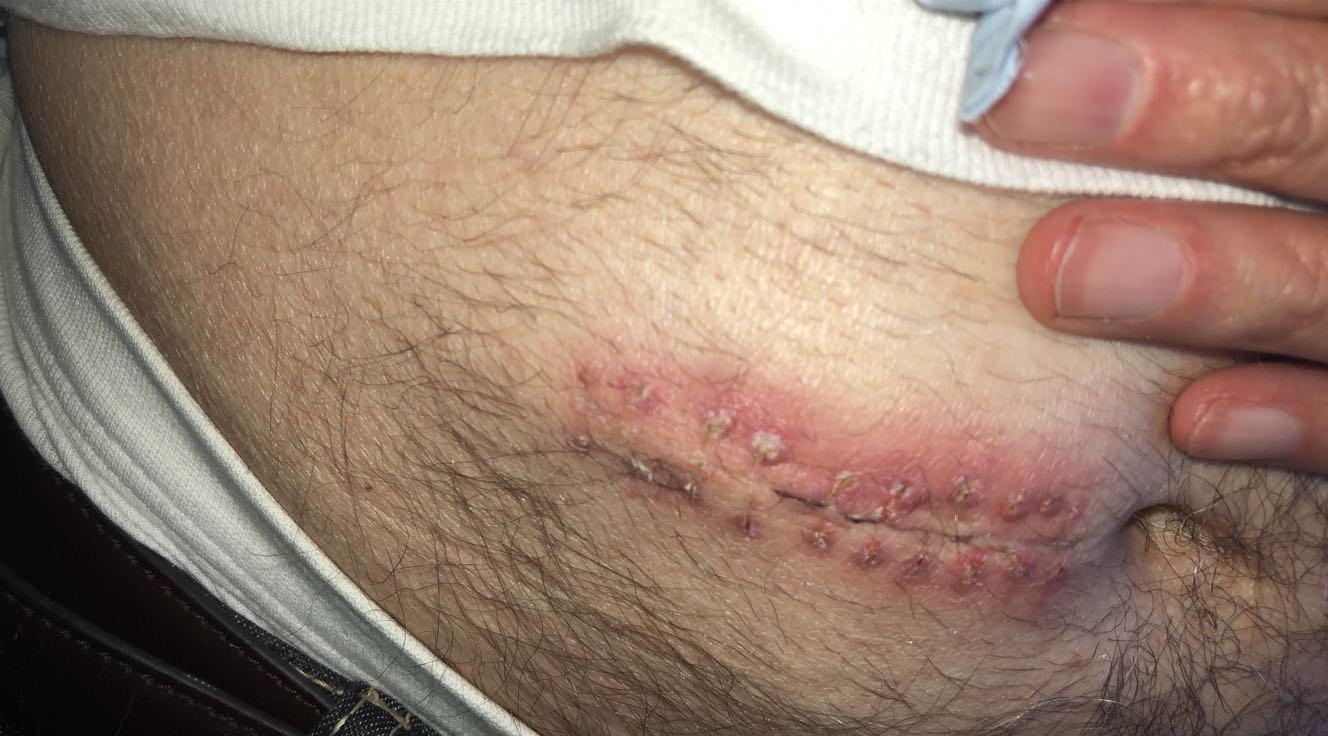 wound healing on stomach